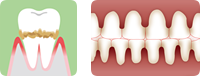 重度の歯周病