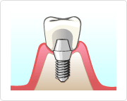 インプラント