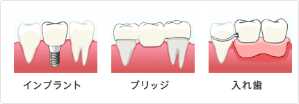 インプラント ブリッジ 入れ歯