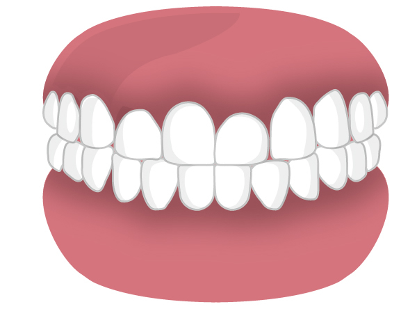 歯周補綴(ほてつ）