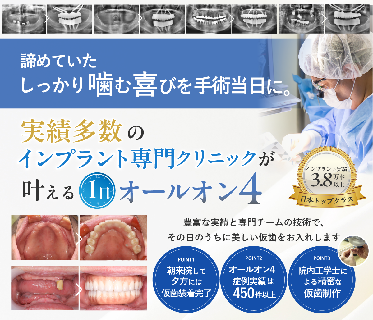 オールオン4（フルマウスインプラント）全ての歯を4本で支える治療