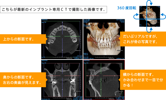 こちらが最新のインプラント専用ＣＴで撮影した画像です。
360度回転
上からの断面です。
奥からの断面です。
左右の奥歯が見えます。
だいぶリアルですが、これが骨の写真です。
横からの断面です。かみ合わせまで一目で分かる！