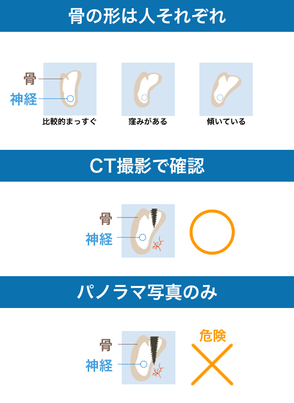 ここが大事!
インプラントを差し込む大事な土台の骨。どこが薄くなってる?骨の形は?全く分かりません。
上顎洞が曇って写ると、「インプラントを差し込む深さ」=「骨の厚み」があるように見えてしまいます。