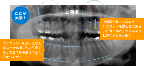 骨の形はそれぞれ
CT撮影で確認
パノラマ写真のみ
