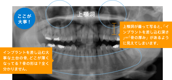 骨の形はそれぞれ
ＣＴ撮影で確認
パノラマ写真のみ