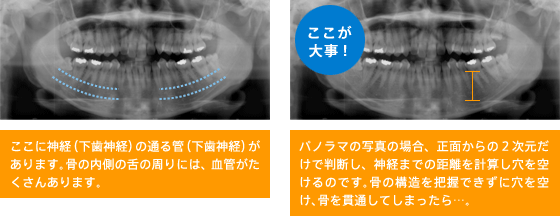 ここに神経(下歯神経)の通る管(下歯神経)があるます。骨の内側の舌の周りには、血管がたくさんあります。
ここが大事!
パノラマの写真の場合、正面からの2次元だけで判断し、神経までの距離を計算し穴を空けるのです。骨の構造を把握できずに穴を空け、骨を貫通してしまったら・・・
