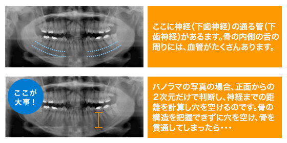 ここに神経(下歯神経)の通る管(下歯神経)があるます。骨の内側の舌の周りには、血管がたくさんあります。
ここが大事!
パノラマの写真の場合、正面からの2次元だけで判断し、神経までの距離を計算し穴を空けるのです。骨の構造を把握できずに穴を空け、骨を貫通してしまったら・・・