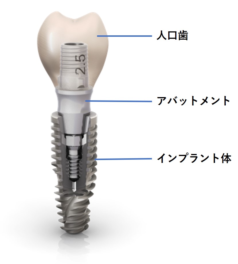 インプラントの材料、人口歯、アバットメント、インプラント体