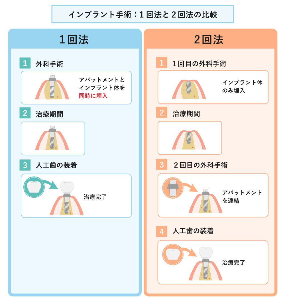 インプラント手術:1回法と2回法の比較