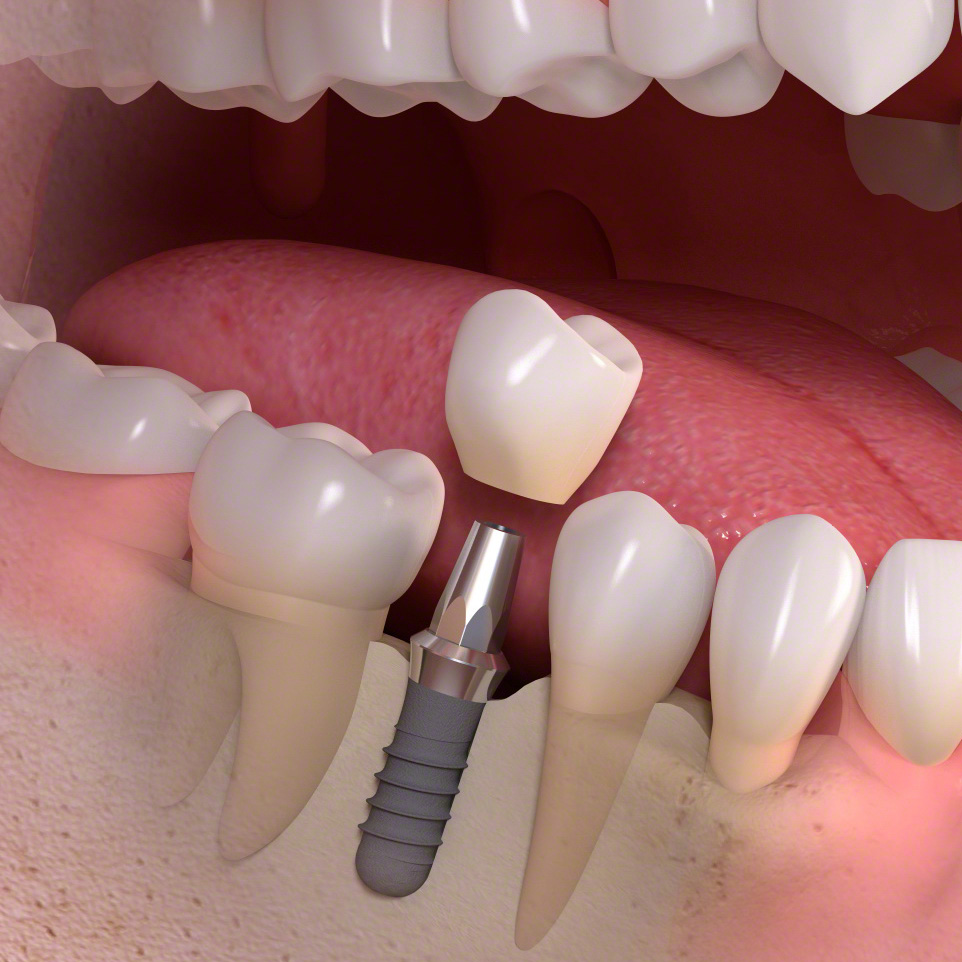 インプラント治療中の歯