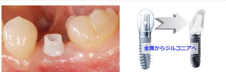 ジルコニアインプラントの特徴